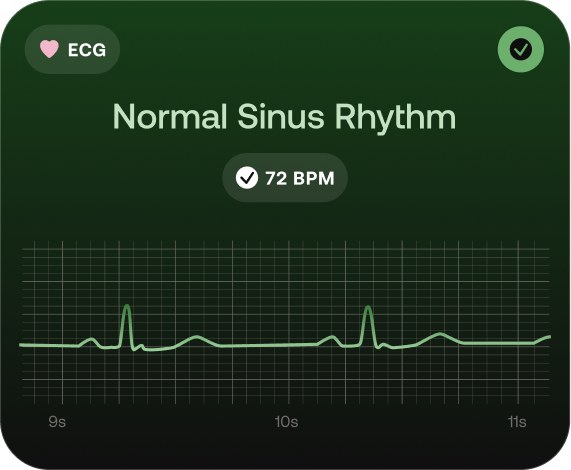 ECG showing normal sinus rhythm at 72 BPM